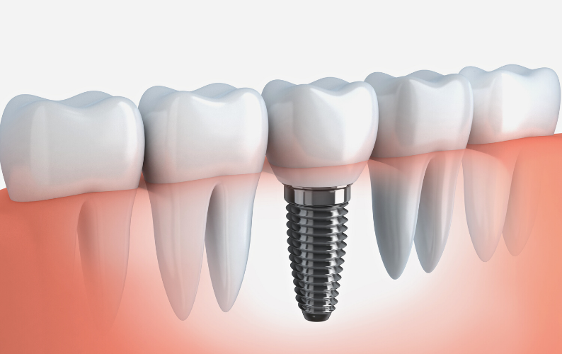 Dental implant in Vaishali Nagar, Jaipur