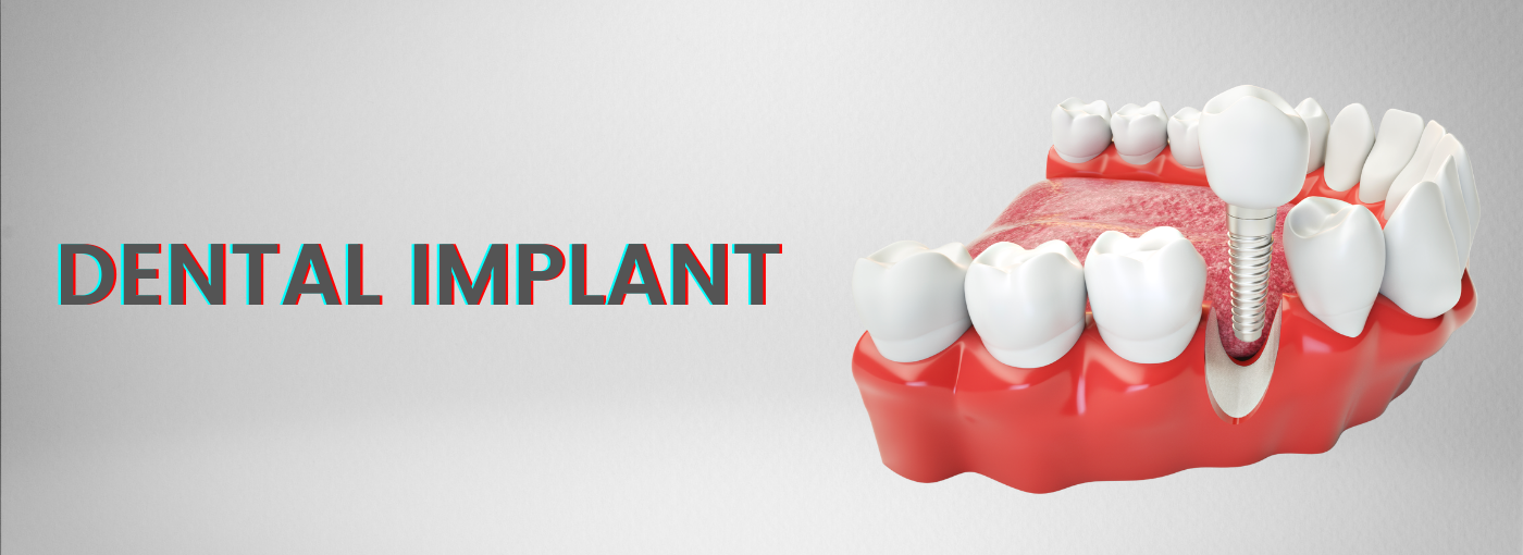 Dental implant in Vaishali Nagar, Jaipur