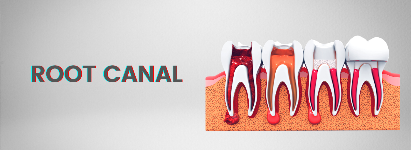 Root Canal Treatment in Vaishali Nagar, Jaipur