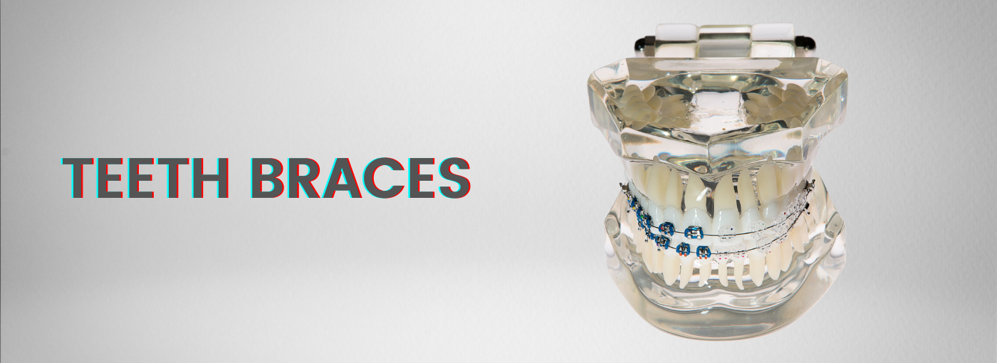 Teeth Braces in Vaishali Nagar, Jaipur