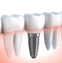 Dental implant in Vaishali Nagar, Jaipur